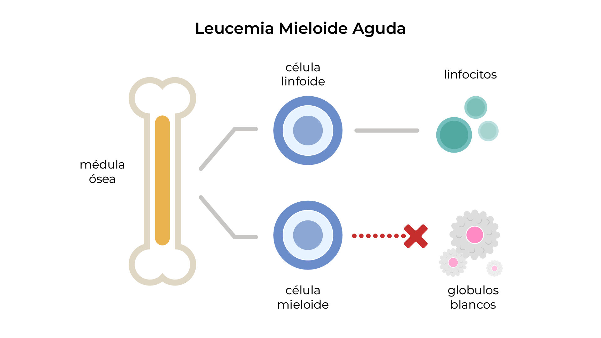 Esquema hematológico de leucemia